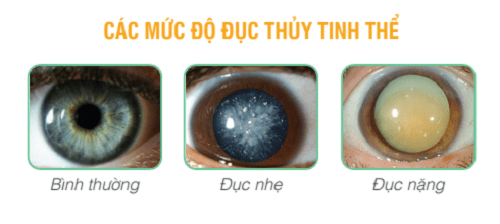 Đục thủy tinh thể làm suy giảm thị lực nặng có thể dẫn đến mù lòa